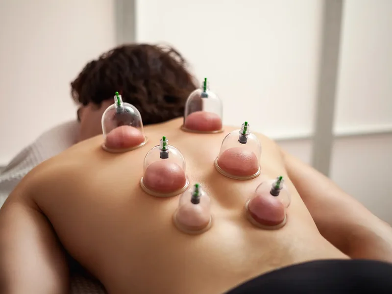 A row of cups placed along a client's back